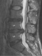 図4:L4､L5､間の椎間板ﾍﾙﾆｱ