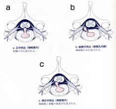 図3:頚の椎間板ヘルニアの種類（水平面）