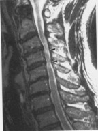 図4:椎間板ヘルニア